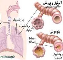 پنوموني در اطفال